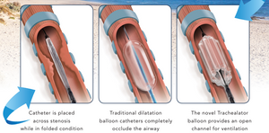 Trachealator Non-occlusive Airway Dilation Balloon